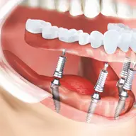 Implanturi dentare vs. proteze tradiționale